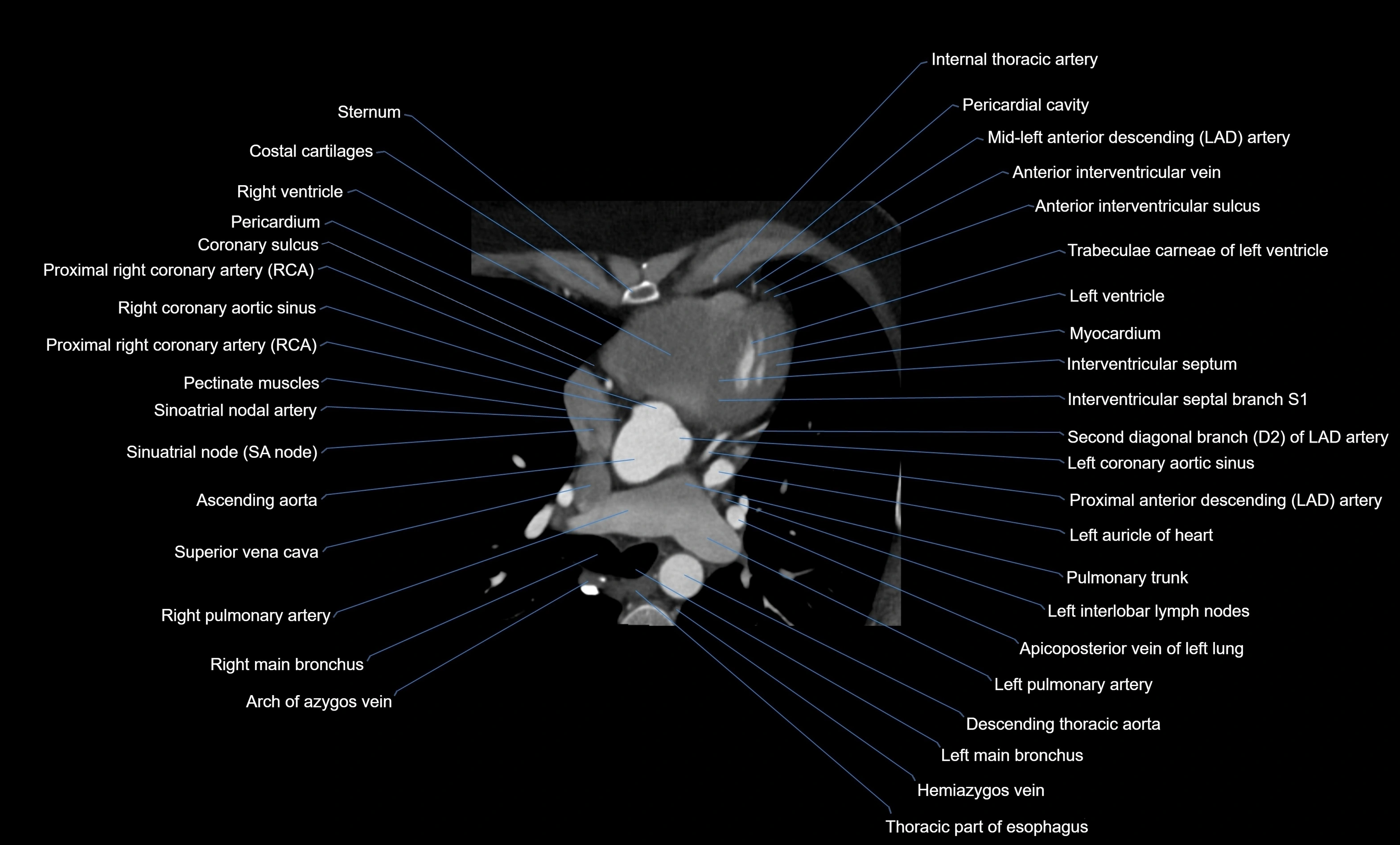 CT heart (coronary angiogram) four chamber view  cross sectional anatomy labelled radiology image -00019.webp